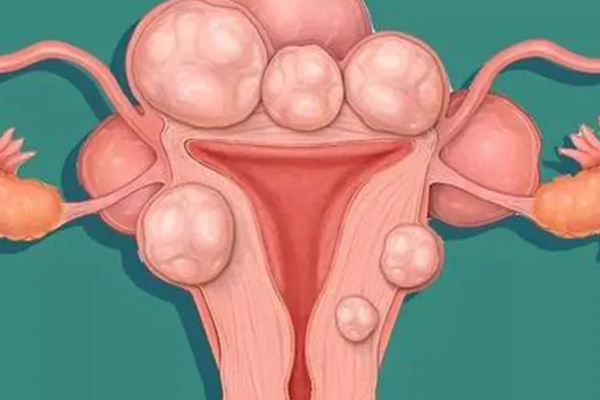 女性有子宫肌瘤会影响做试管婴儿吗？